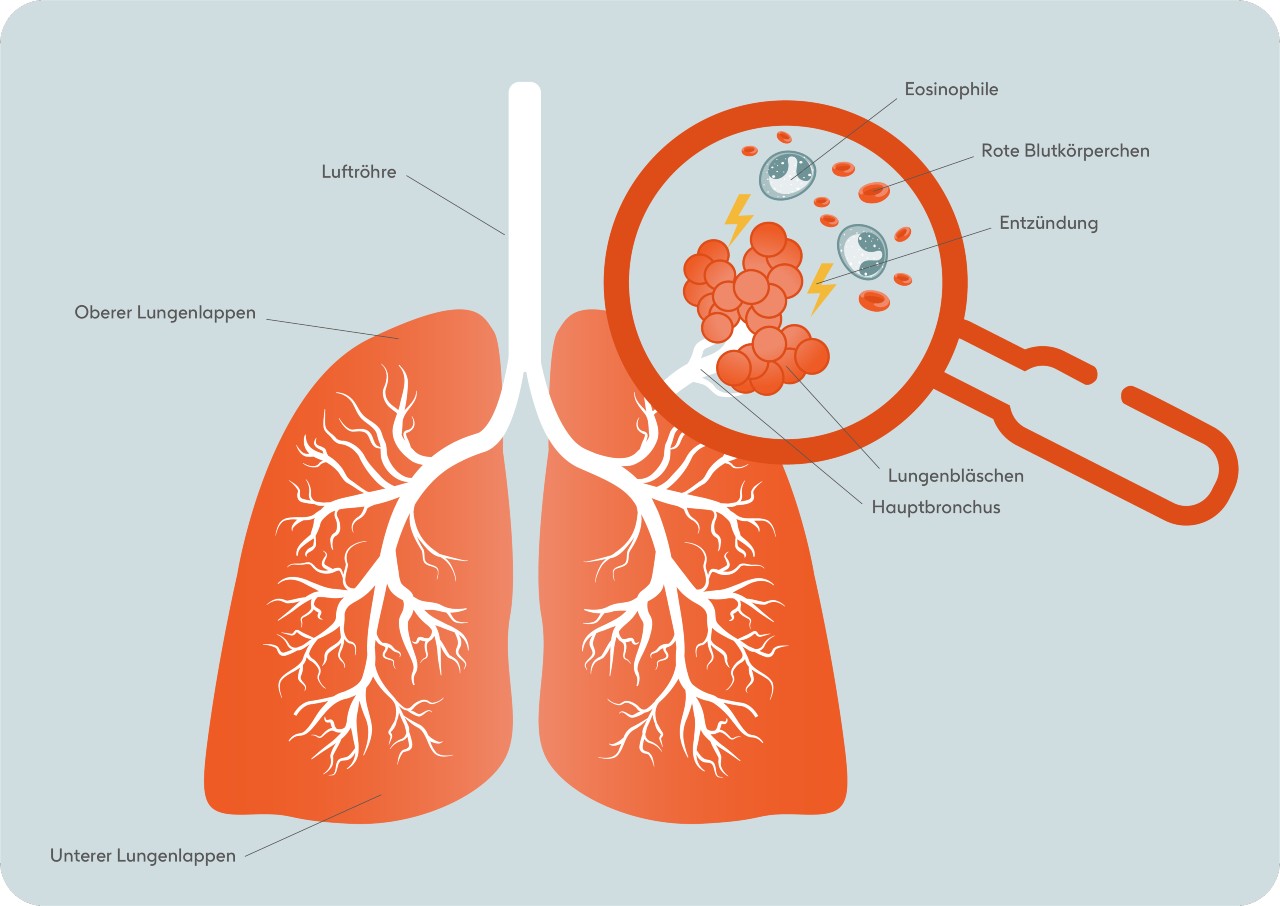 Grafische Darstellung des Entzündungsprozess in der Lunge bei EGPA